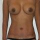 lipofilling