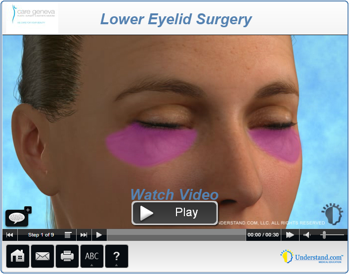 Eyelid shop surgery procedure