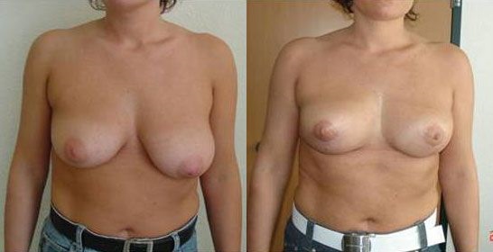 reduction-mammaire-patient3a
