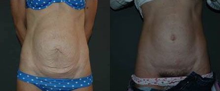 abdominoplastie-patient2a