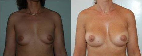 augmentation-mammaire-patient10a