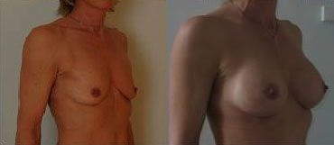 augmentation-mammaire-patient12b