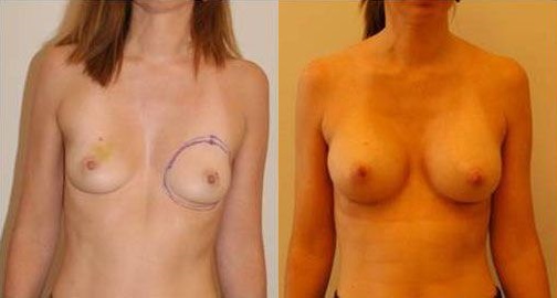 augmentation-mammaire-patient5a