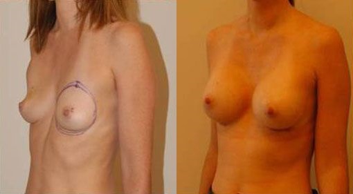 augmentation-mammaire-patient5b