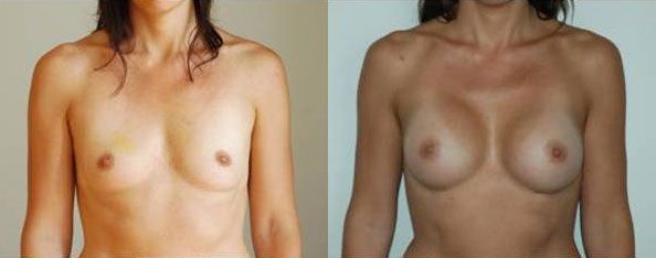 augmentation-mammaire-patient9a