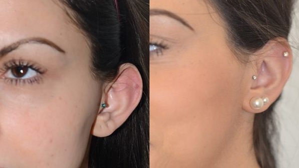 chirurgie-des-oreilles-patient3b