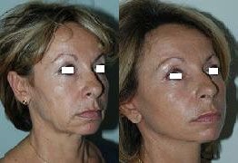 lifting-cervico-facial-patient1b