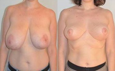 reduction-mammaire-patient1a