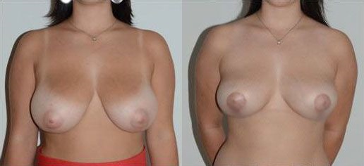 reduction-mammaire-patient5a
