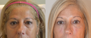 Hyaluronic acid for treatment of tear trough deformity