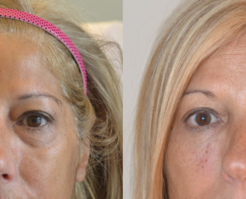 Hyaluronic acid for treatment of tear trough deformity