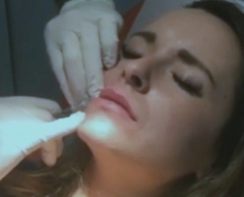 Prolonger l'effet d'Injection d'acide hyaluronique