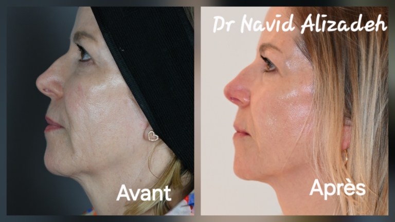 Juläine in Geneva: before and after treatment by Dr Navid Alizadeh, photo 2