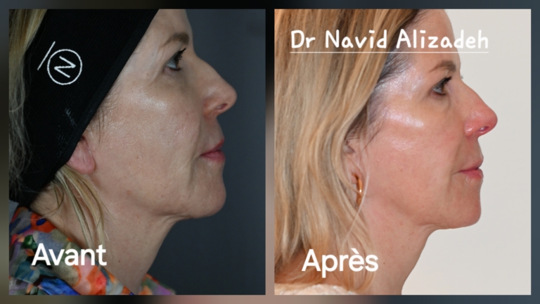 Juläine in Geneva: before and after treatment by Dr Navid Alizadeh, photo 3