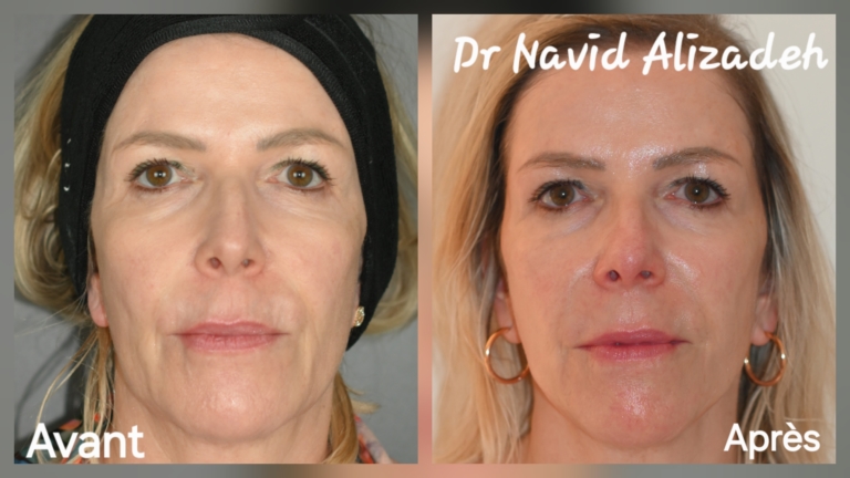 Juläine in Geneva: before and after treatment by Dr Navid Alizadeh, photo 1
